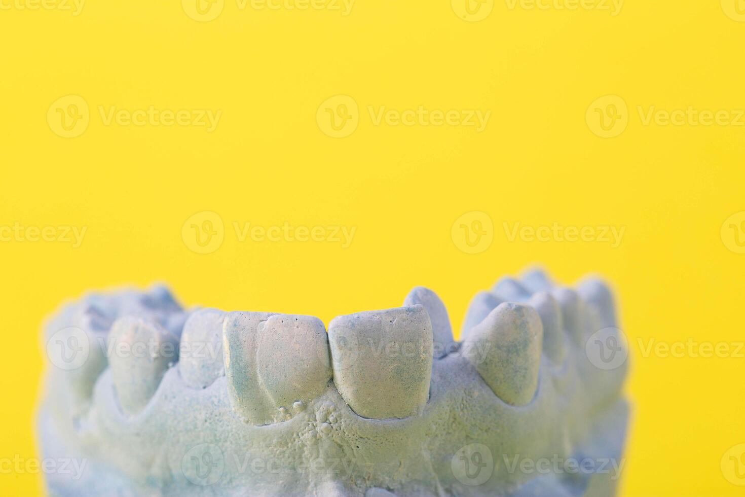 Blue plaster model of an impression of a patient's jaw at an orthodontist dentist on a yellow background. Manufacturing of dentures and crowns for dental prosthetics in orthodontics, macro. photo