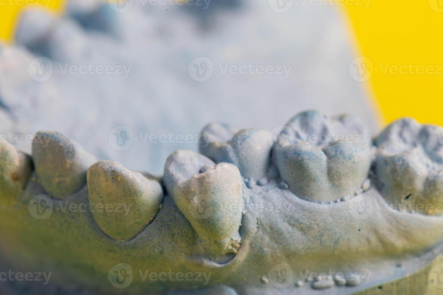 Blue plaster model of an impression of a patient s jaw at an orthodontist s dentist, close-up. Crooked teeth, correction of malocclusion, macro photo