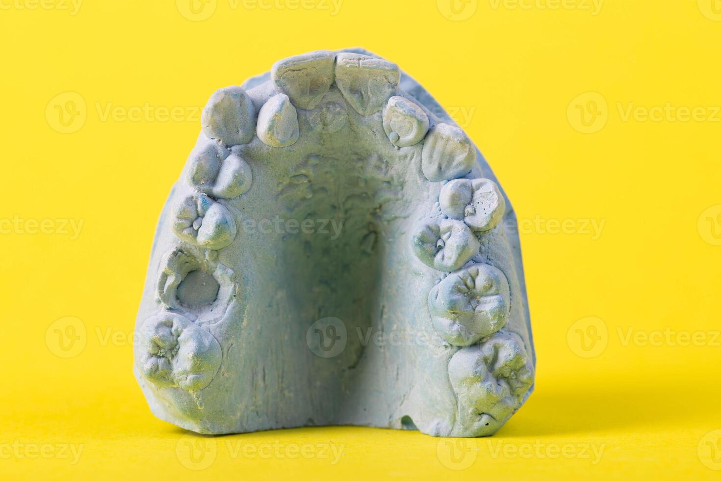 Blue plaster impression of a patient's dental jaw with crooked teeth and malocclusions on a yellow background. Manufacturing of braces to correct bite. View from above. Copy space for text photo