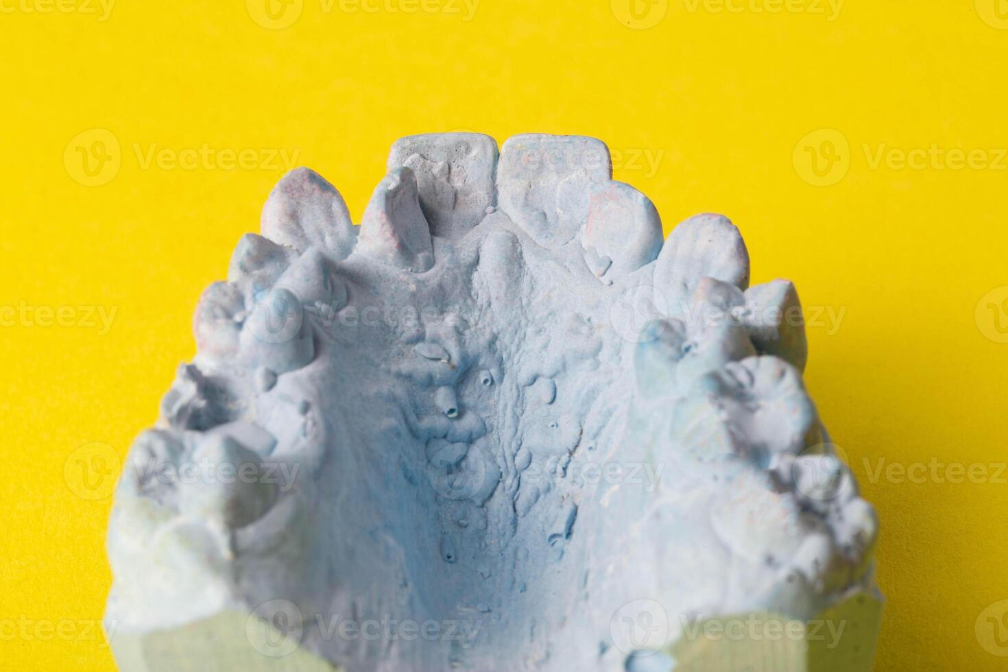 Blue plaster impression of a patient's dental jaw with crooked teeth and malocclusions on a yellow background. Manufacturing of braces to correct bite. View from above. Copy space for text photo