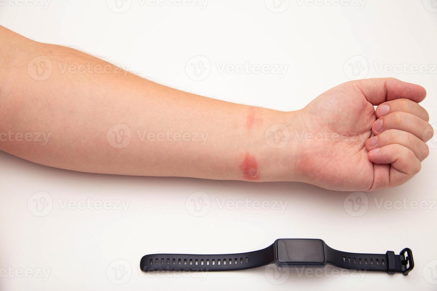 Redness and allergies on a person s wrist from wearing a fitness bracelet with a silicone strap. Contact dermatitis, close-up photo
