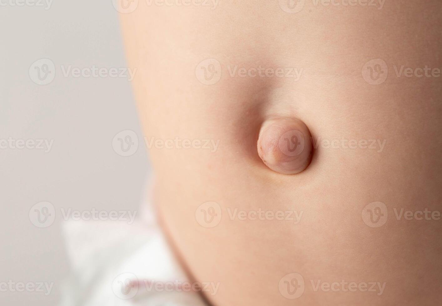 Umbilical hernia in a newborn baby on the stomach. Treatment of umbilical hernias in children without surgery, medical. Close-up photo