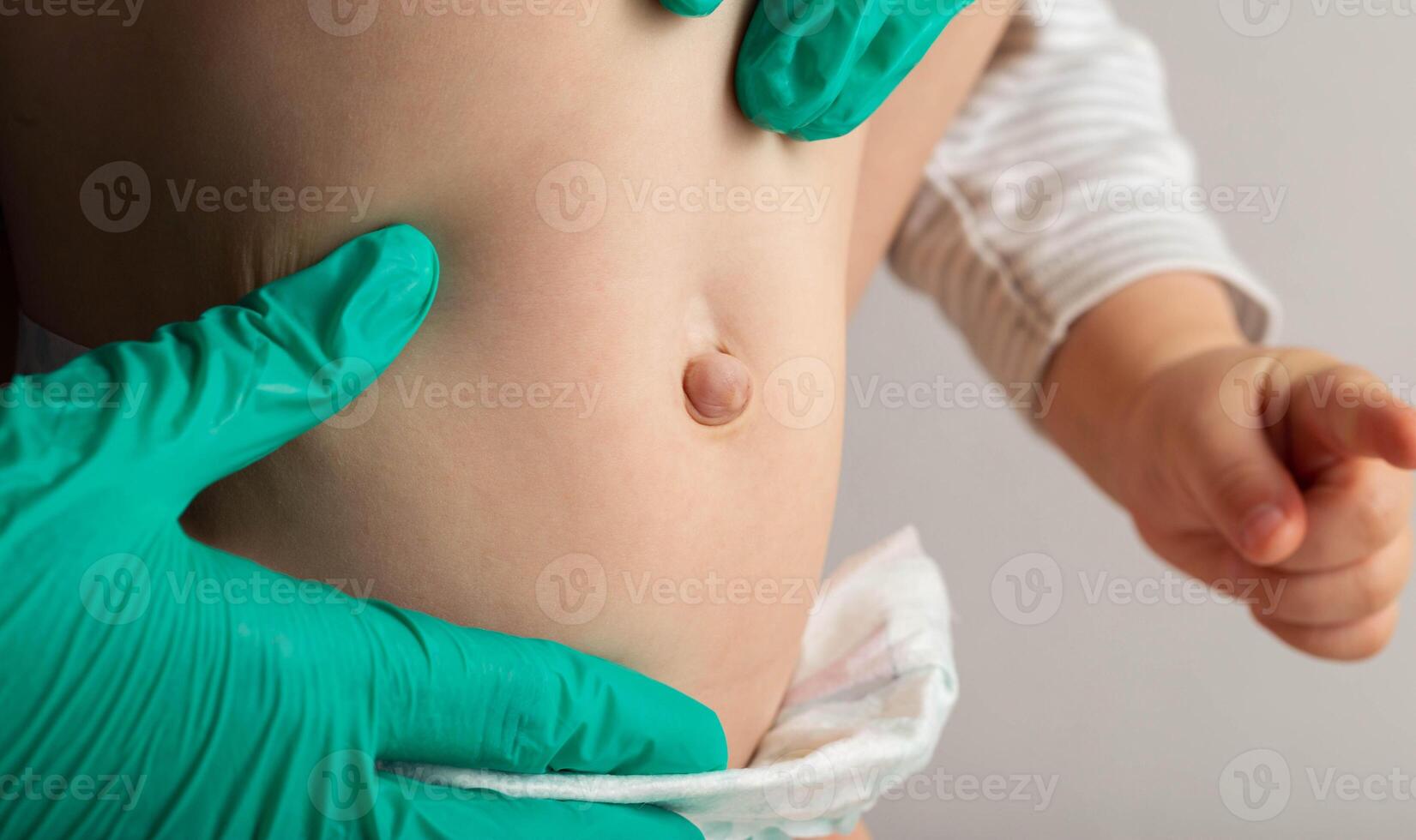 A doctor surgeon in medical gloves examines the abdomen of a newborn baby with an enlarged umbilical ring and an umbilical hernia, close-up, medical photo
