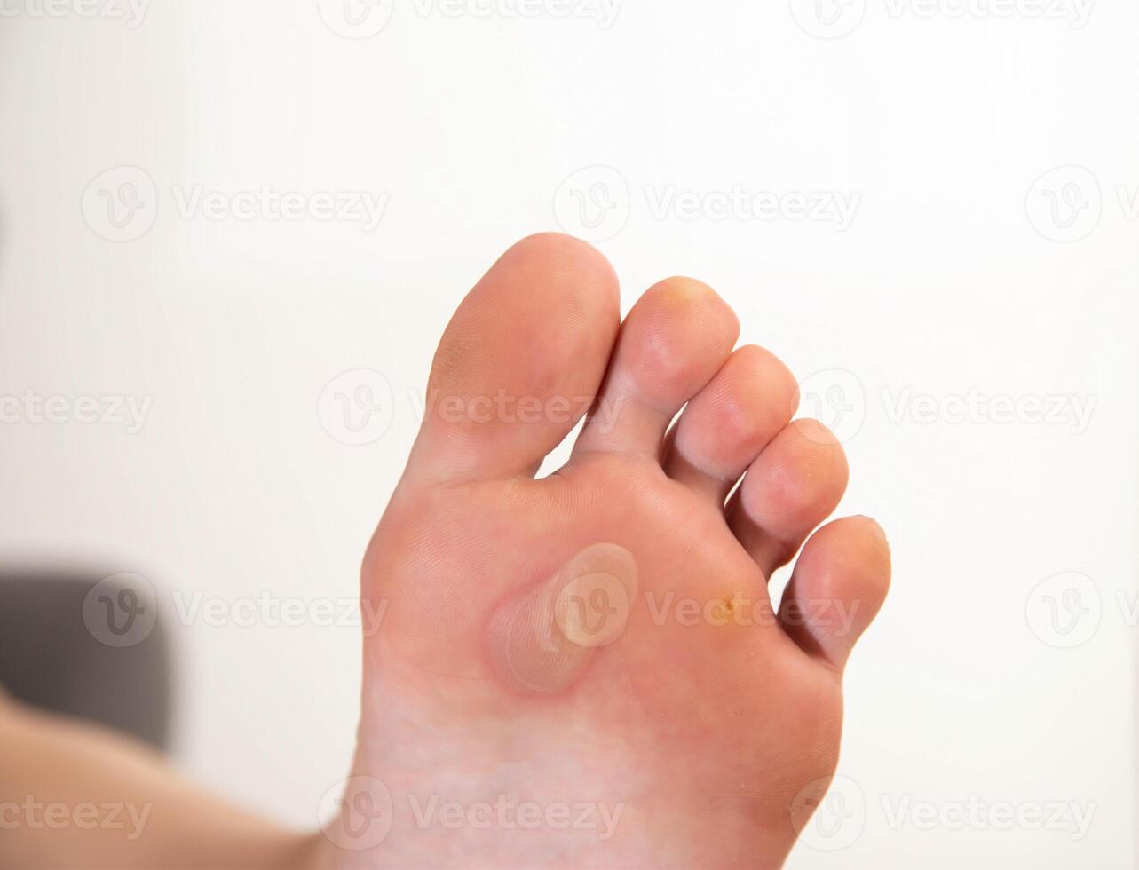 A person's foot has a large callus on its foot due to rubbing from uncomfortable shoes. Rod wart on the sole of the foot, close-up photo