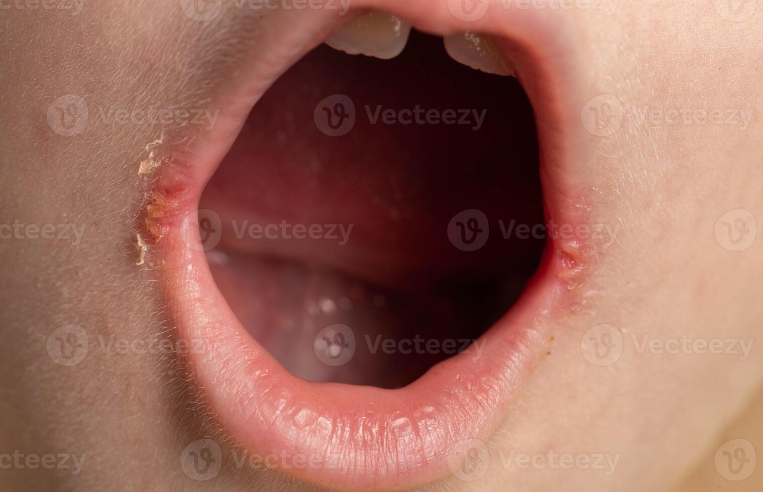 Seizures on the corners of the lips of a child s mouth. Bacterial disease of inflammation of the corners of the lips. Angular stomatitis with reduced immunity in a child, macro photo