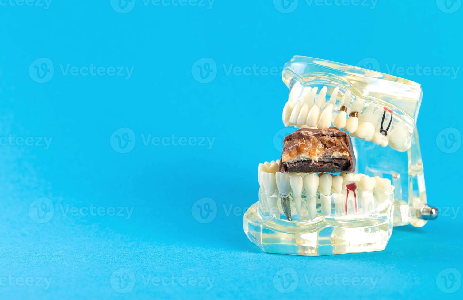 A bitten chocolate bar in a dental jaw mockup on a blue background. The concept of sweets harming tooth enamel, caries. Copy space for text photo