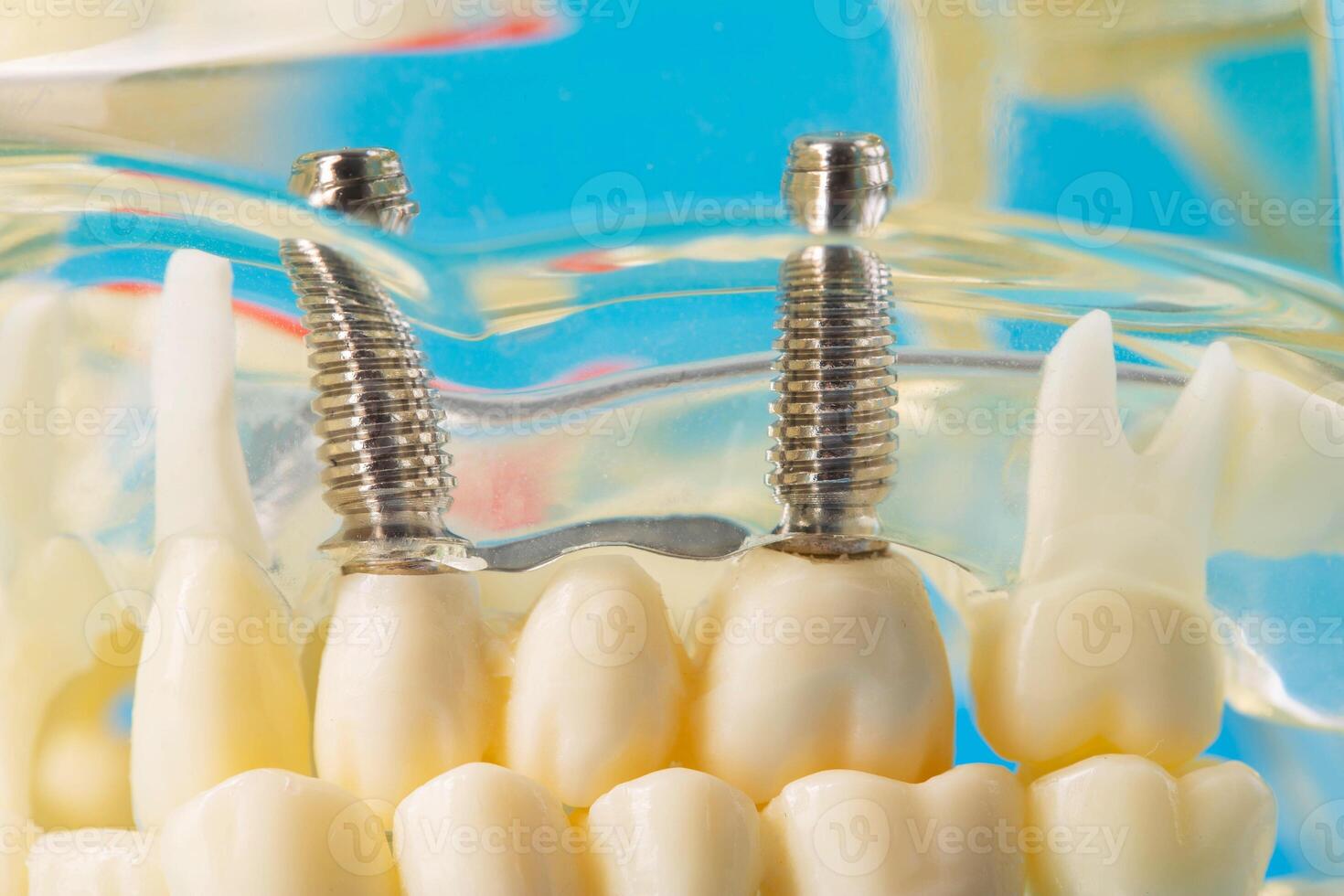 Medical model of a patient's dental jaw with pins in the gums and dental implants. Unerupted wisdom teeth, close-up. photo