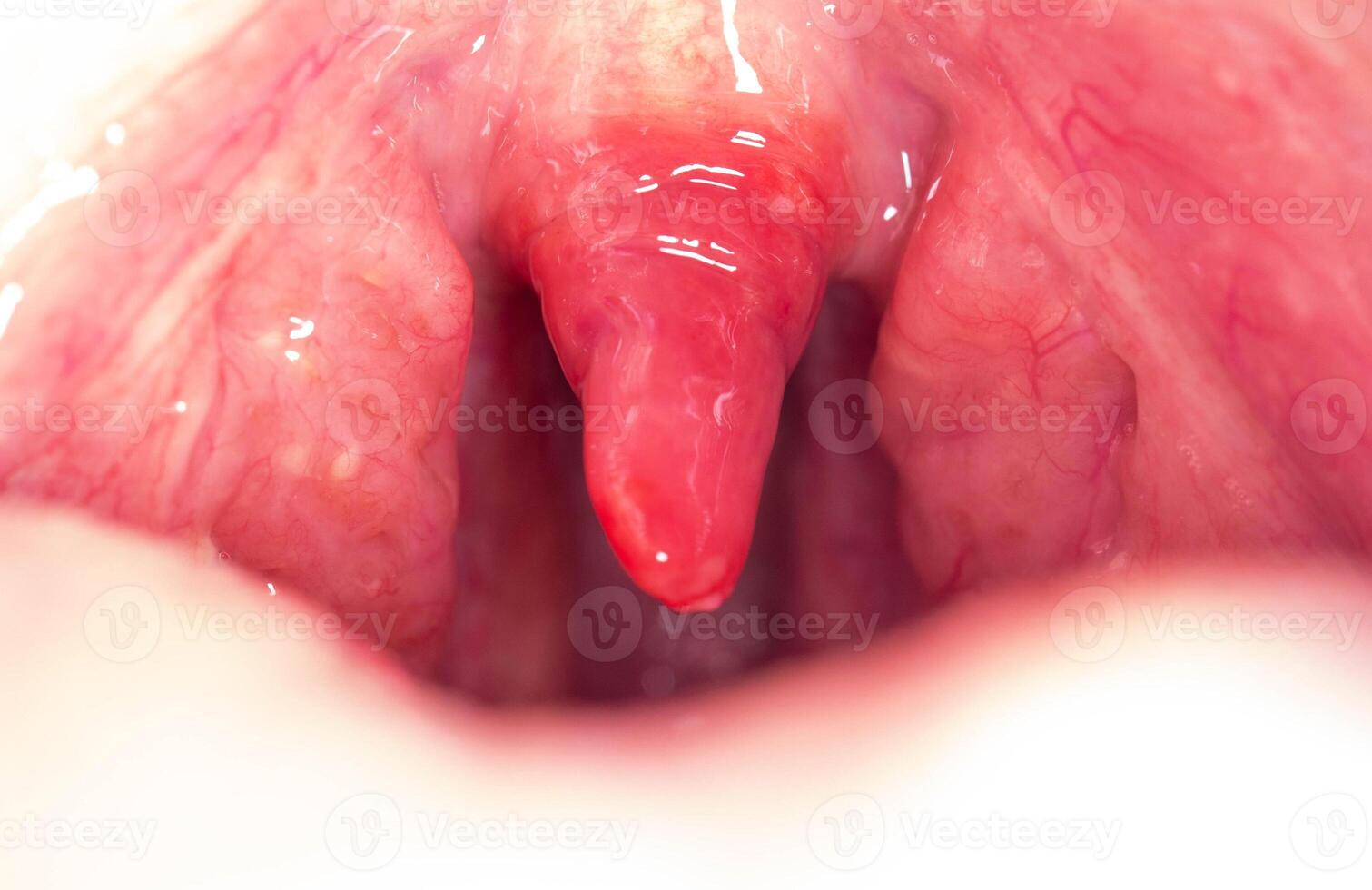 Long uvula with inflammation of infections and viruses. Treatment of uvulitis in children and adults. Sore throat, sore throat, macro photo