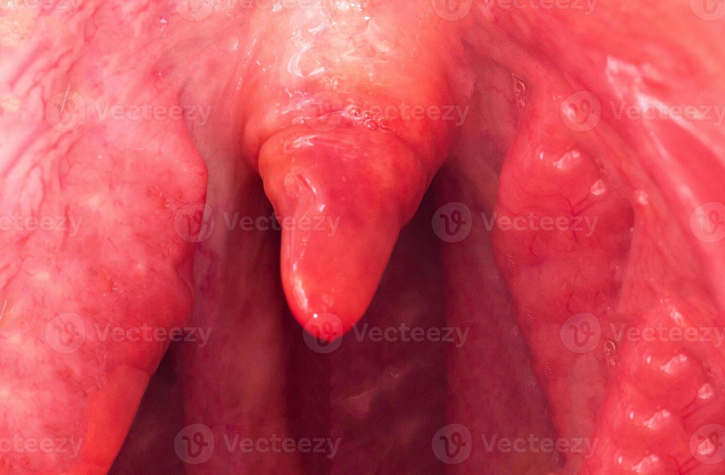 Uvulitis and sore throat in the oral cavity due to illness. Inflammation of the uvula and tonsils due to infections during illness, close-up, streptococcus photo