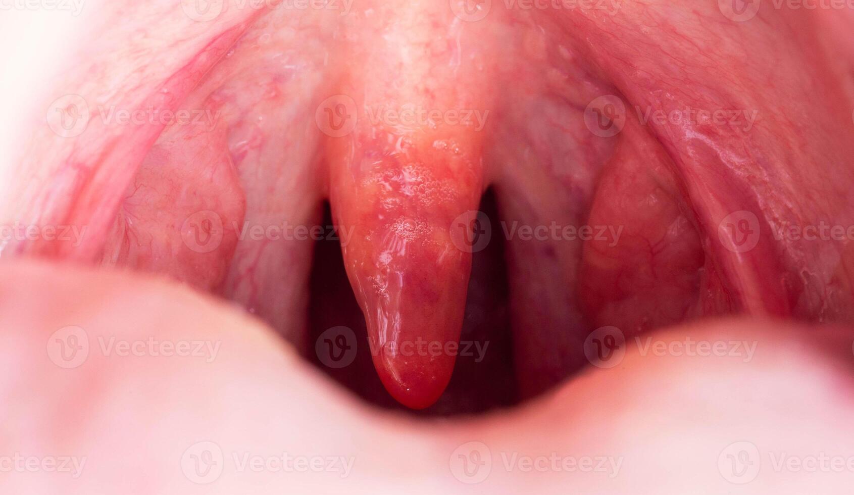 Inflammation of the uvula in the oral cavity due to infection and virus. Treatment of the disease is uvulitis. Red throat due to illness, close-up photo