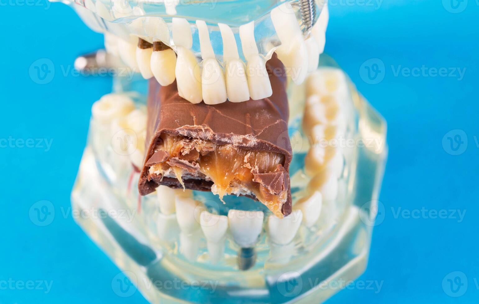 A bitten piece of chocolate in a dental jaw mockup on a blue background. The concept of the effect of sugar and leftover food on teeth and tooth enamel. Tooth destruction by bacteria photo