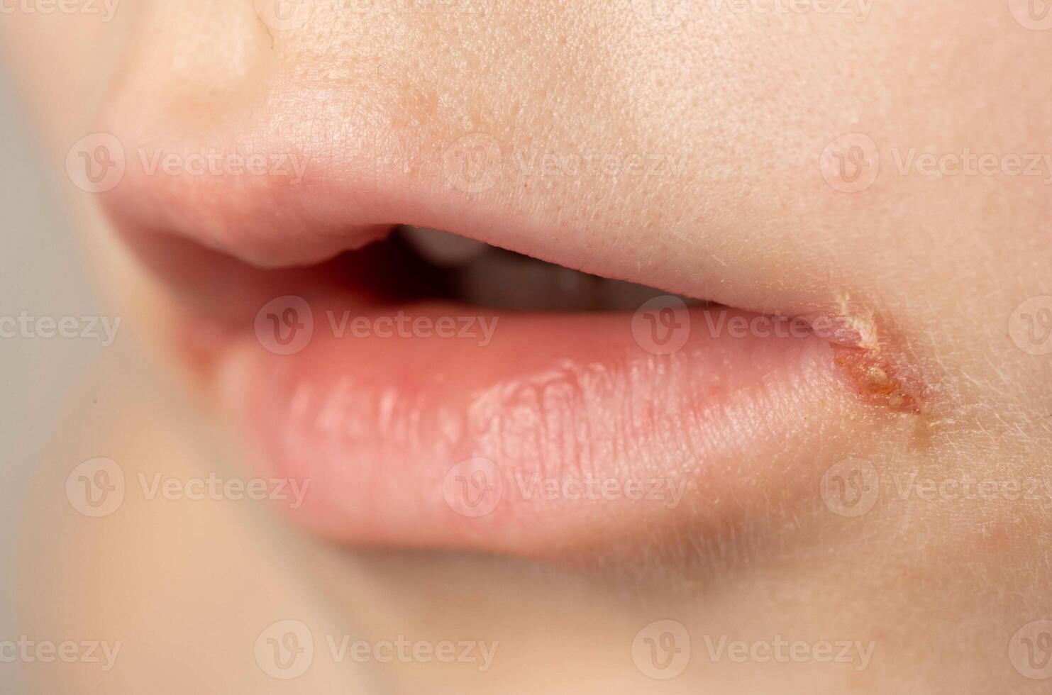 Seizures on the corners of the lips of a child s mouth. Bacterial disease of inflammation of the corners of the lips. Angular stomatitis with reduced immunity in a child, macro photo