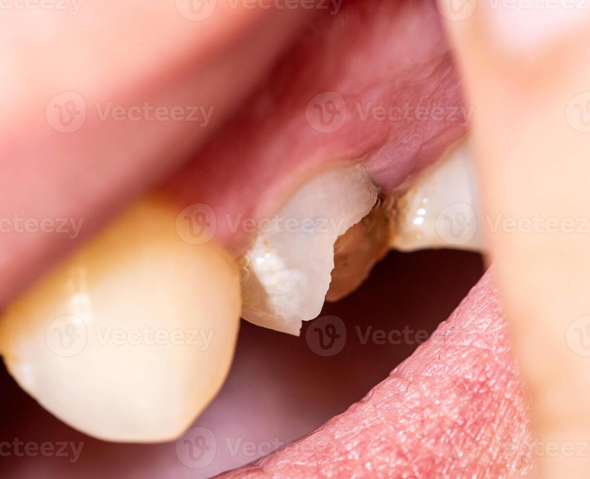Chipped piece of a dead pulp tooth. Restoration of a damaged tooth in dentistry, defect in tooth enamel, thin tooth walls. Macro photo