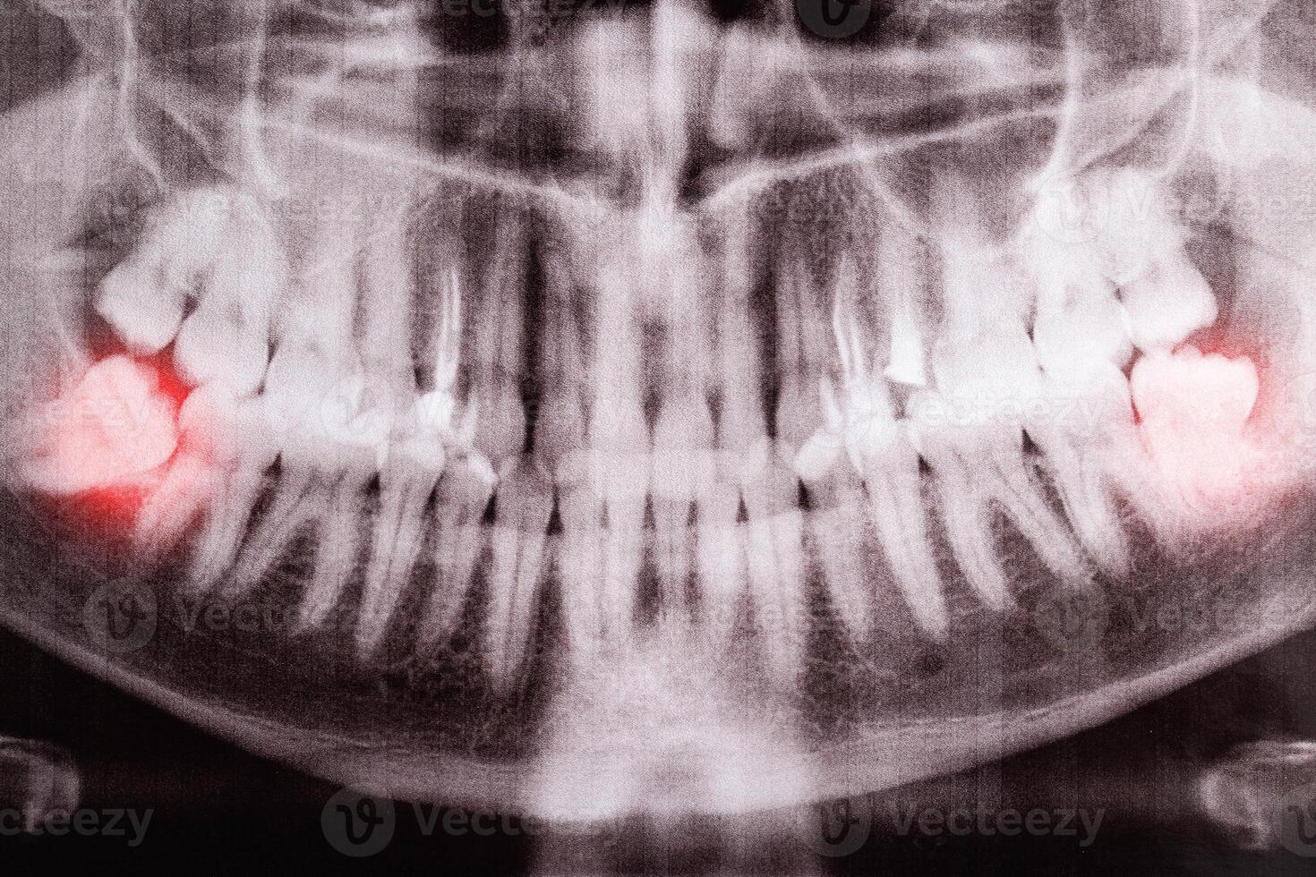 Impacted wisdom teeth on an X-ray picture with an inflamed cyst neoplasm. Removal of wisdom teeth in dentistry. Pericoronaritis photo