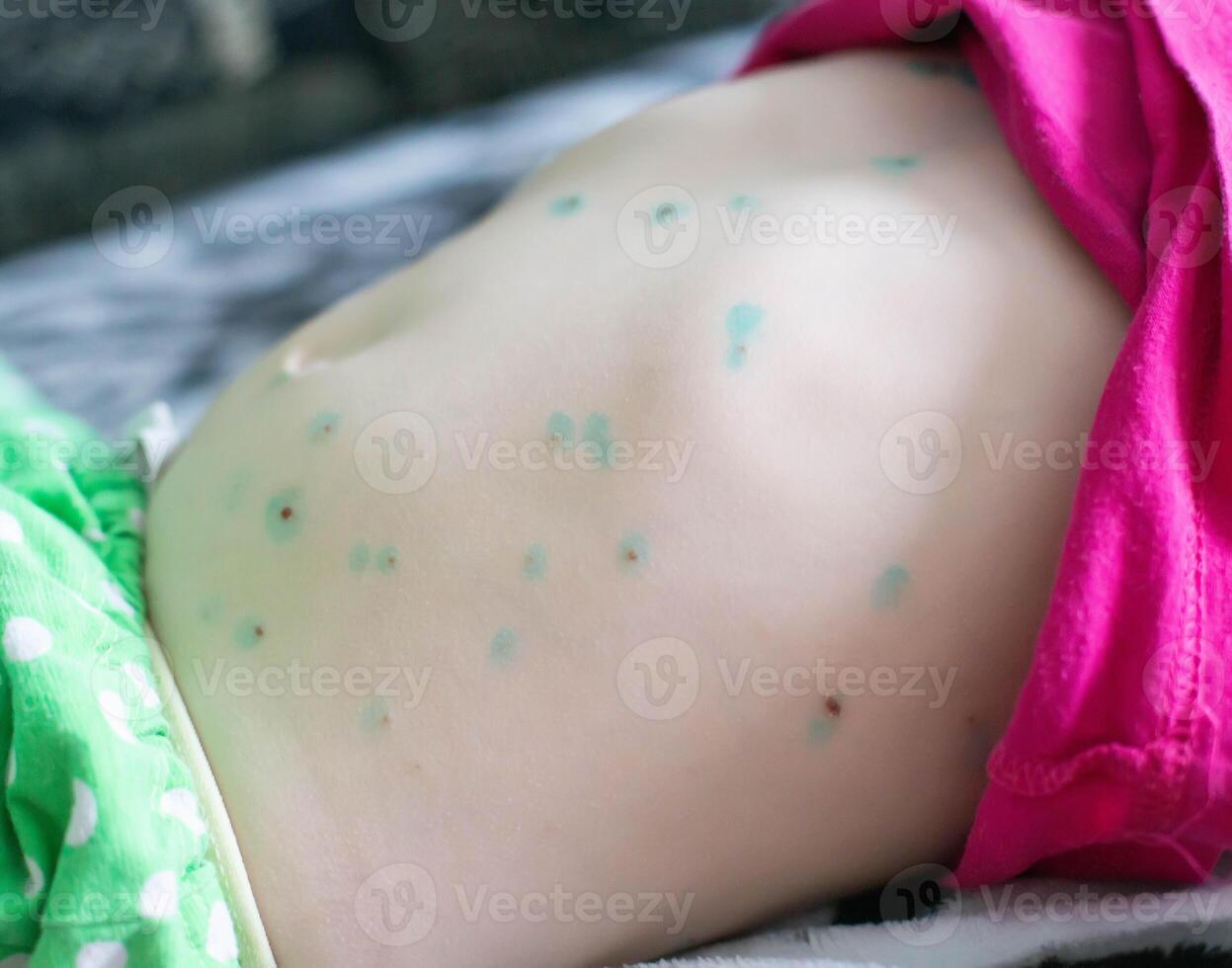 A rash on the skin of the abdomen in a child infectious disease chickenpox, infection photo