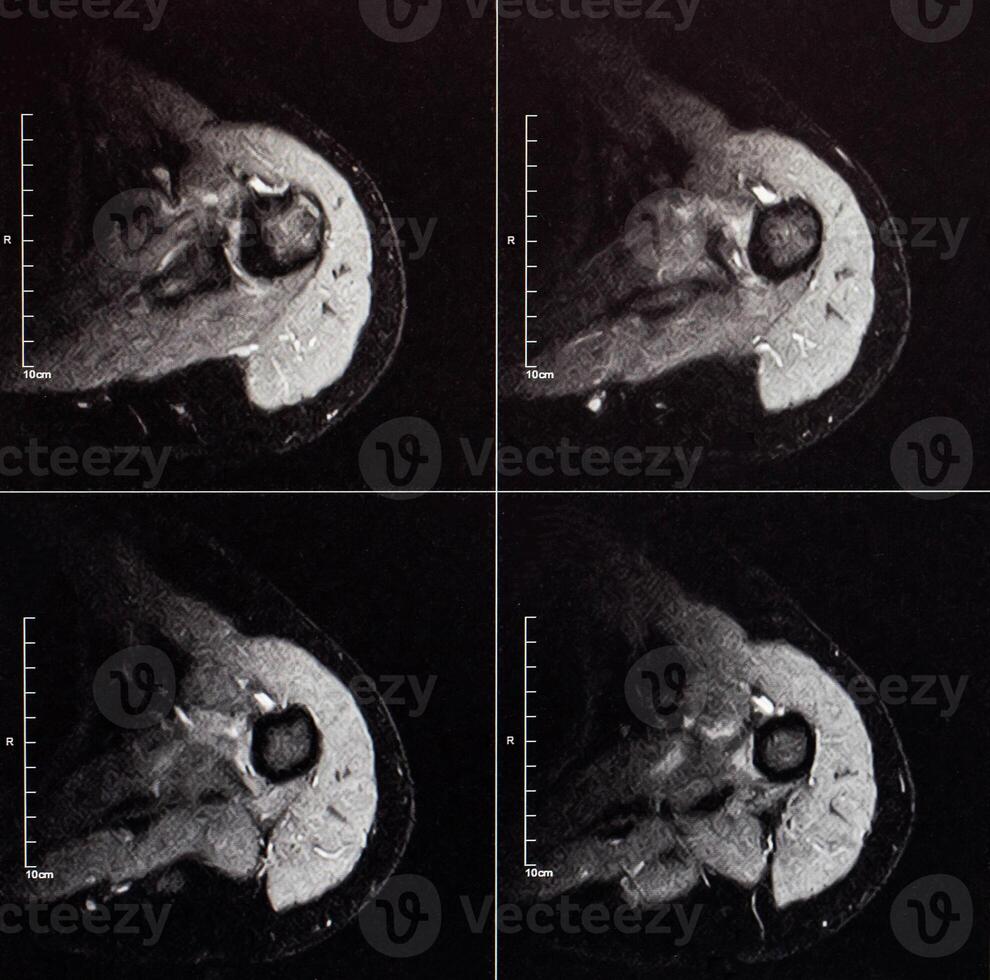 MRI image of the shoulder joint after a fracture and dislocation. Impression fracture of the humeral head. Damage to the joint capsule, joint deformation, arthrosis, close-up photo
