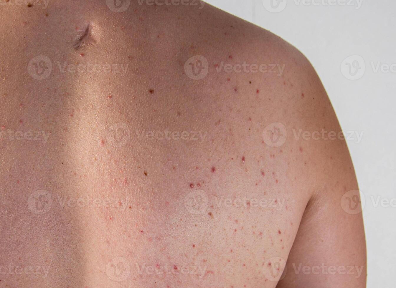 A man has a scar and red pimples on his skin due to poor hygiene. Inflammation of the sebaceous glands, close-up photo