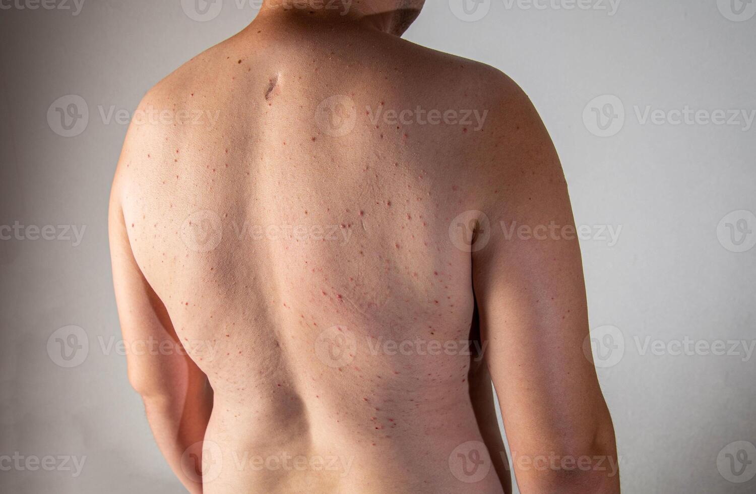 Red pimples on a man's back. Concept of inflammation of the sebaceous glands, dermatology, close-up photo
