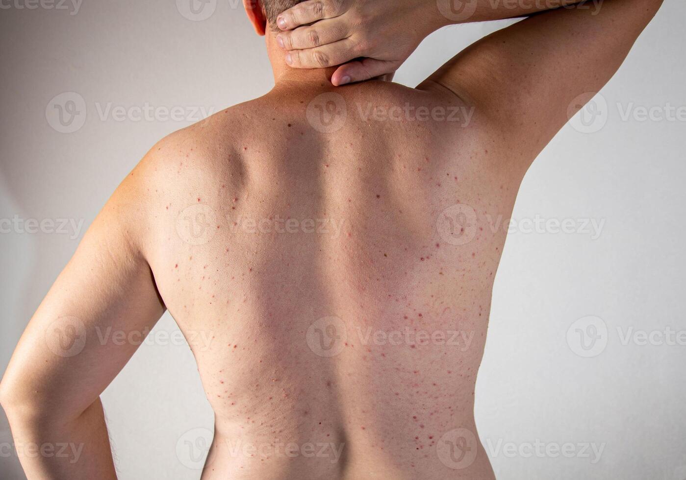 Red pimples on a man's back. Hormonal imbalance and increased testosterone, close-up photo