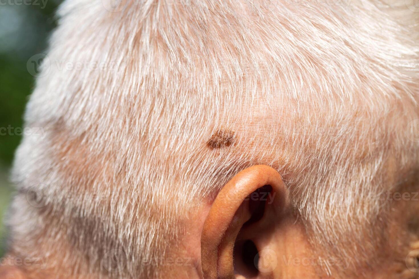 Brown mole on the head of an elderly person, nevus and melanoma, close-up, dermatology photo