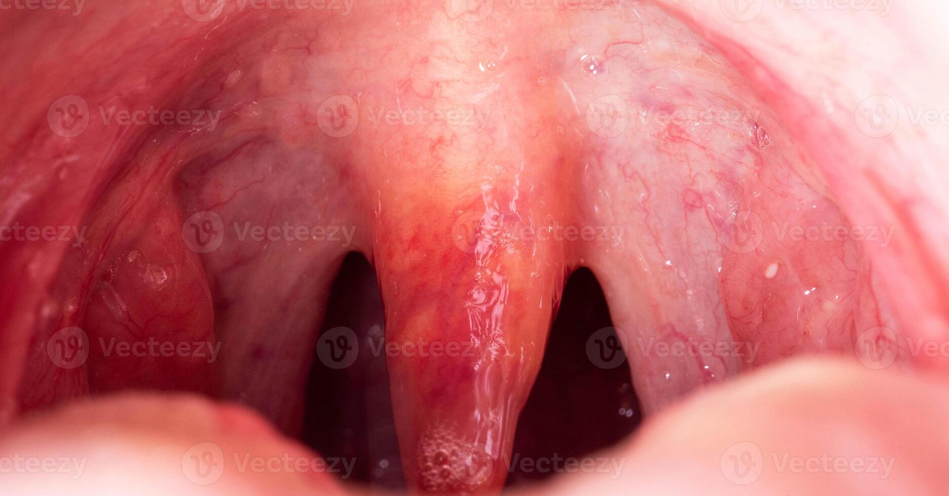 Inflammation of the uvula in the oral cavity due to infection and virus. Treatment of the disease is uvulitis. Red throat due to illness, close-up photo