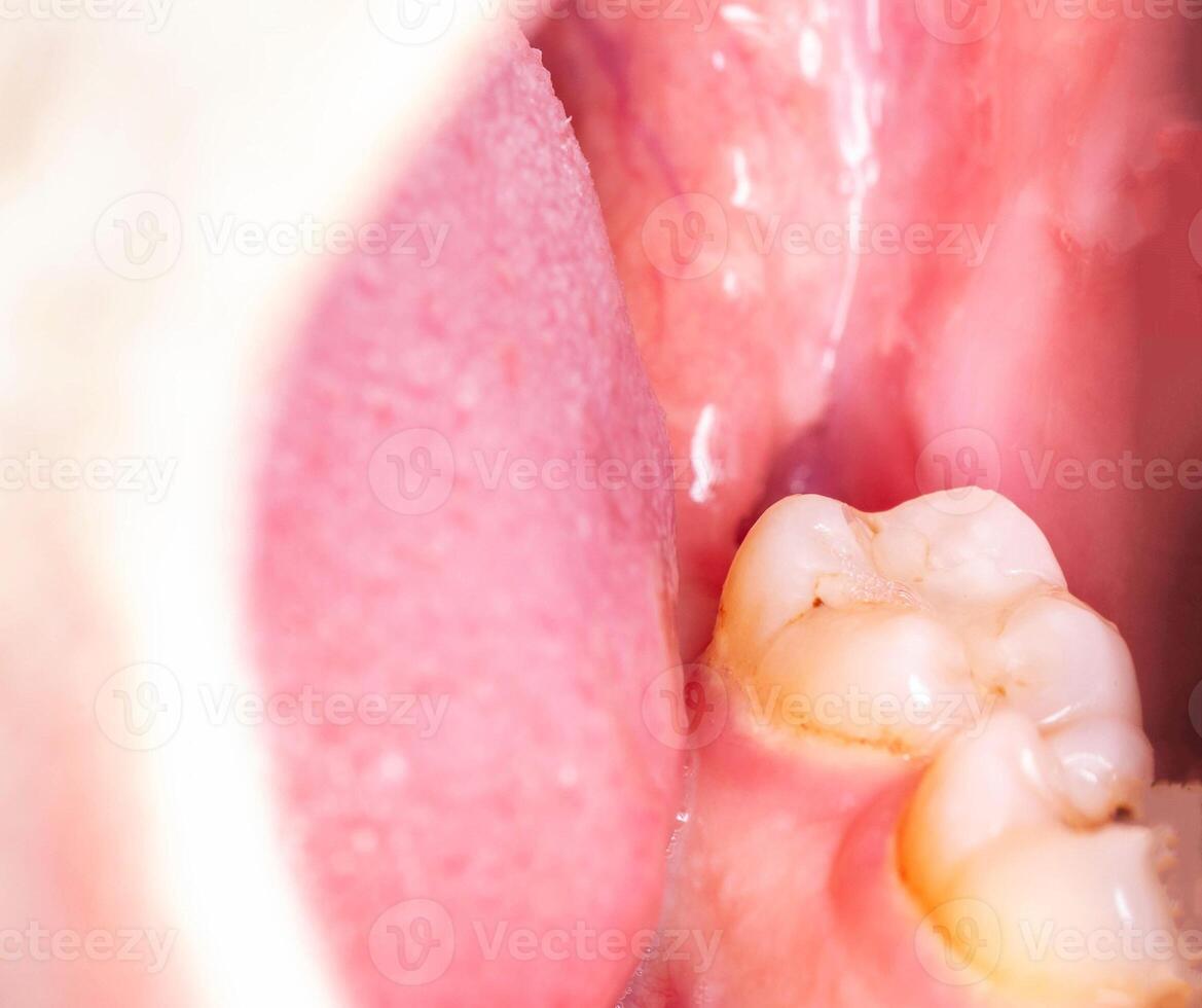 recess after complex impacted wisdom tooth extraction, traumatic healing. Dry socket, alveolitis, macro. Copy space for text photo