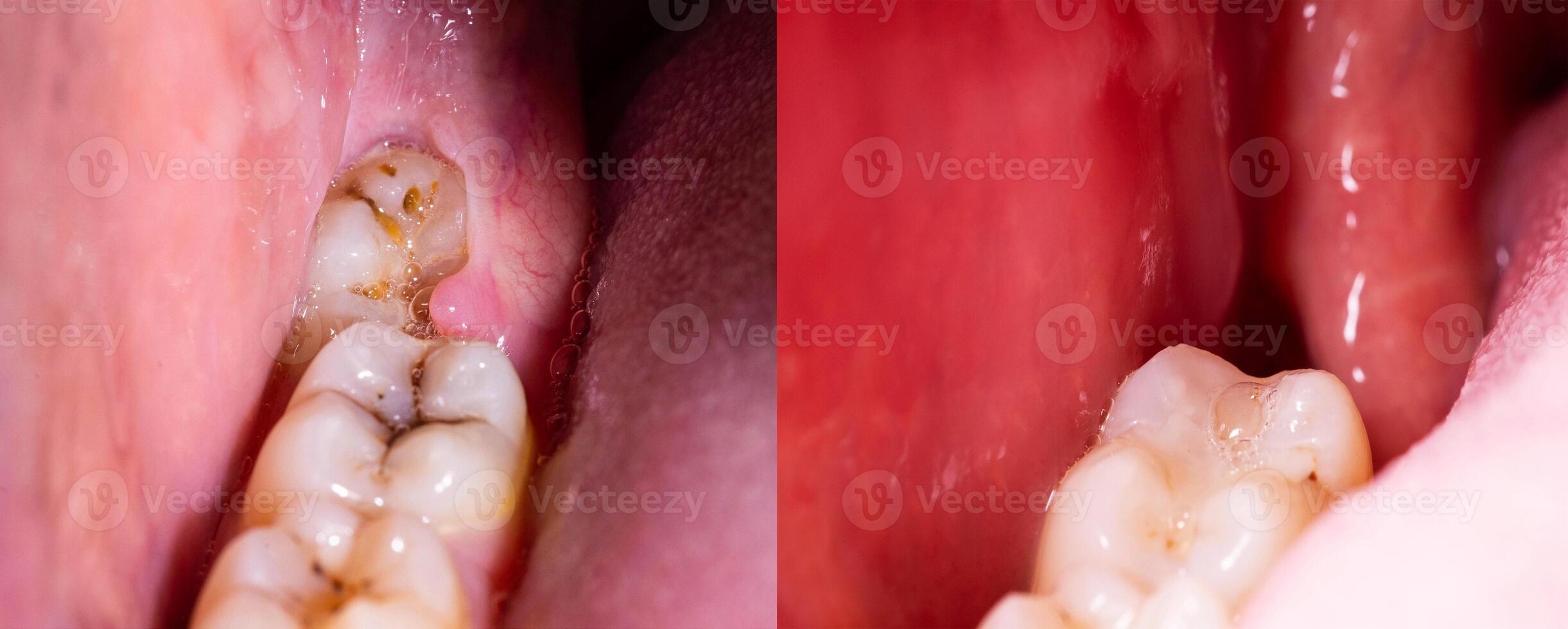 Photo before and after removal of an impacted wisdom tooth. A cavity in the jaw after tooth extraction, macro.