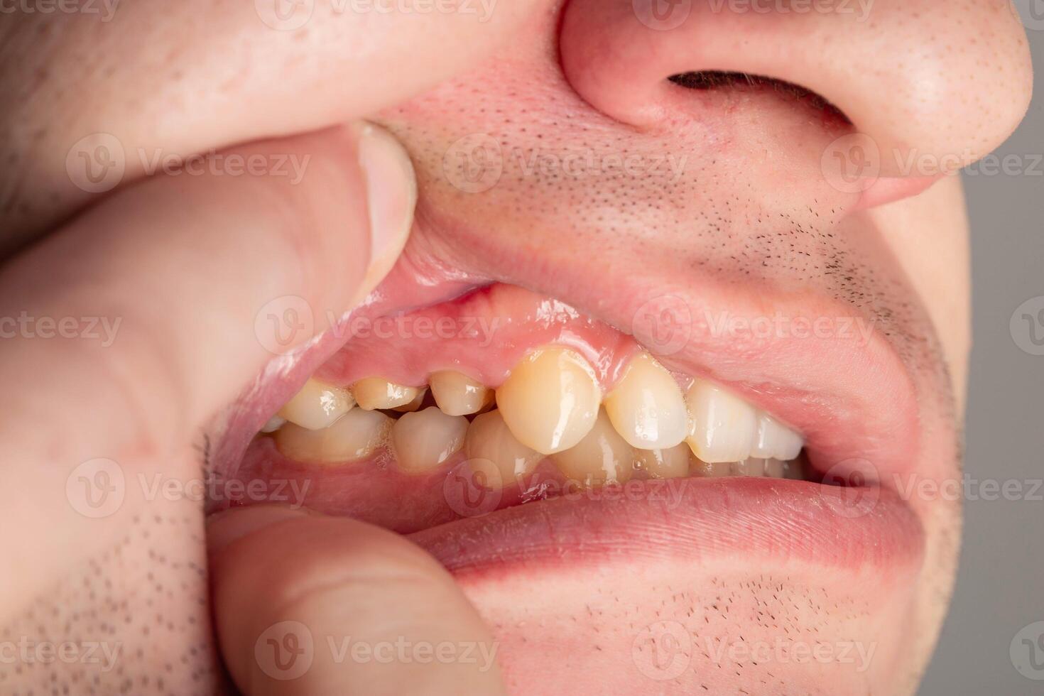 Ground prepared teeth before installing a porcelain fused-to-metal crown for decayed teeth. Prosthetics in dentistry, macro photo