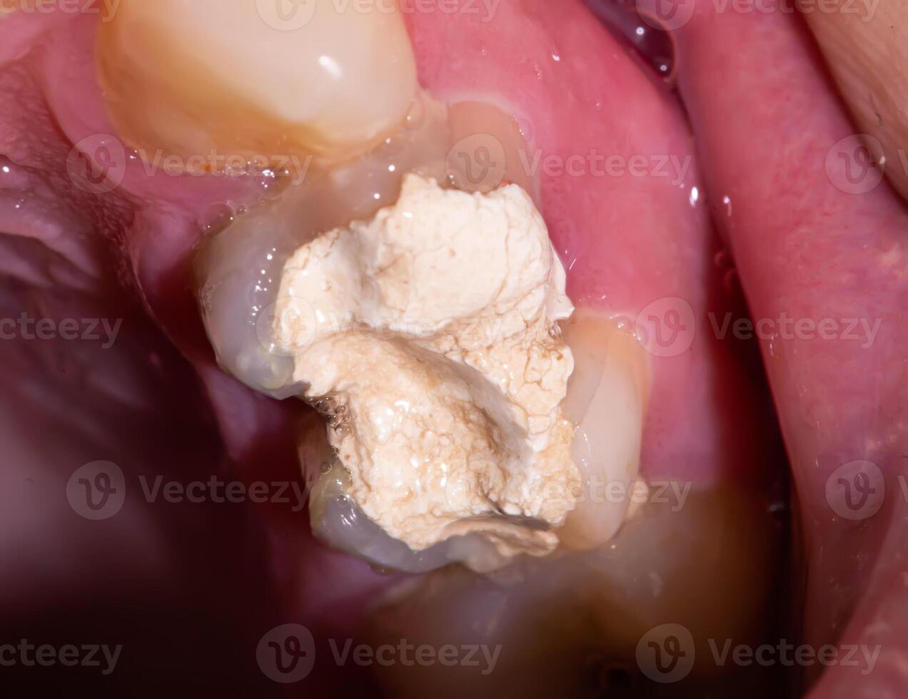 Tooth with temporary filling for nerve destruction and pulpitis treatment, macro. Dentistry photo