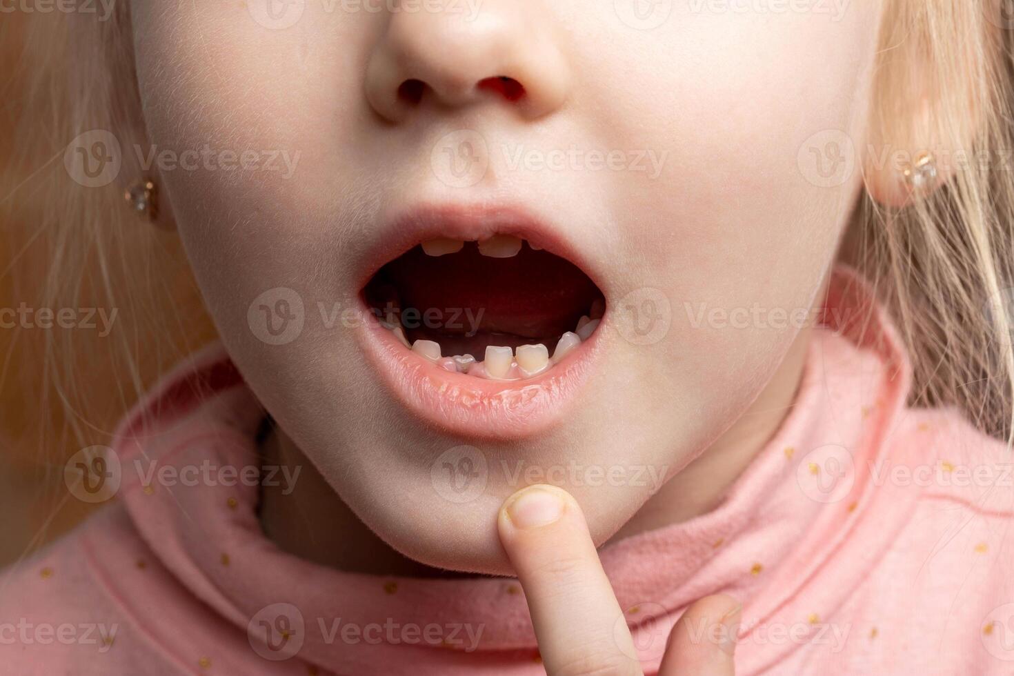 A child with an open mouth without one milk tooth in the jaw. Change of milk teeth. Bleeding gums, close-up photo
