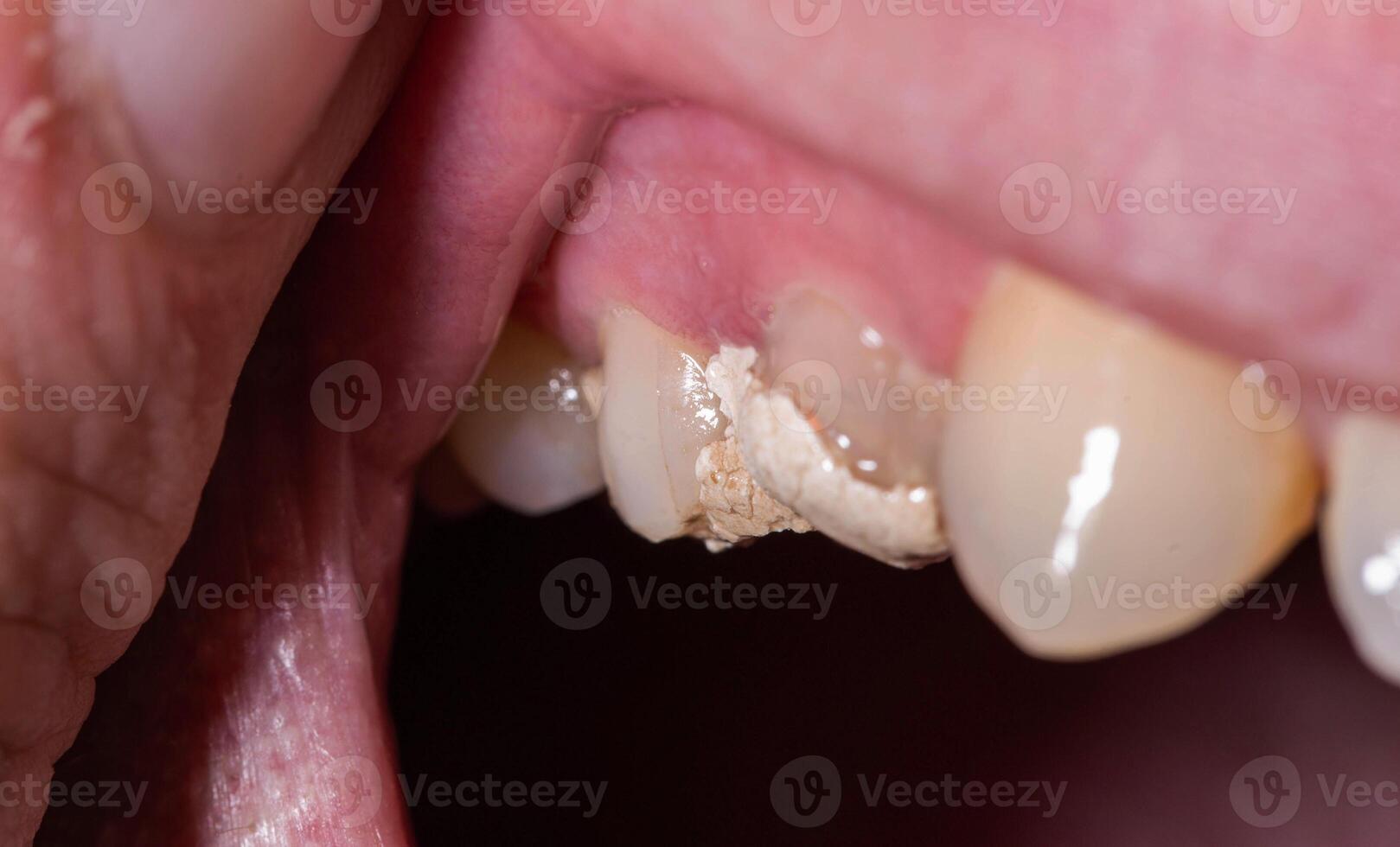 Tooth with temporary filling for nerve destruction and pulpitis treatment, macro. Dentistry photo