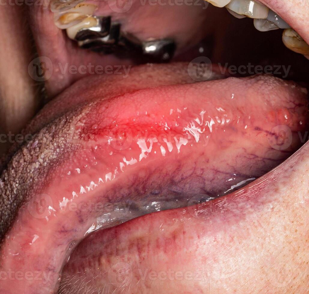 Inflammatory disease in the tongue. Red spot, glossitis. Hygiene of the tongue, close-up. Symptom of vitamin deficiency and bacteria photo