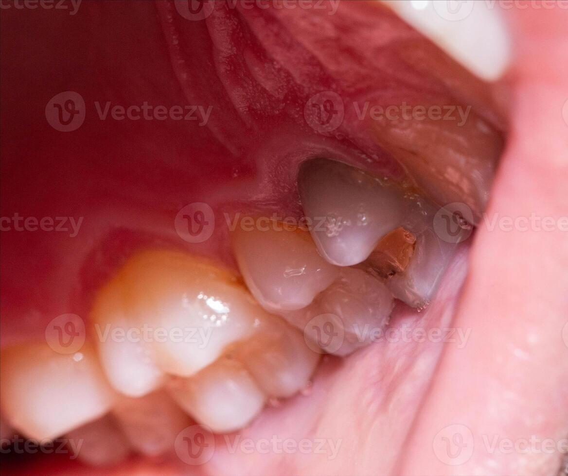 Gray darkened tooth after nerve removal and pulpitis disease. Lack of tooth nutrition, restoration and restoration of a dead tooth in modern dentistry photo