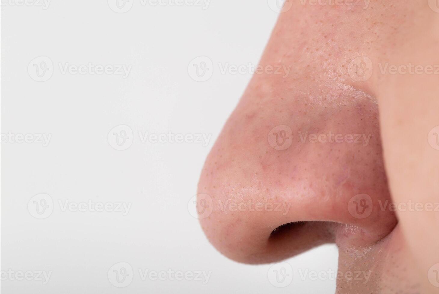 A man has a wide fleshy big nose, close-up. Nose reduction plastic surgery concept, copy space for text photo