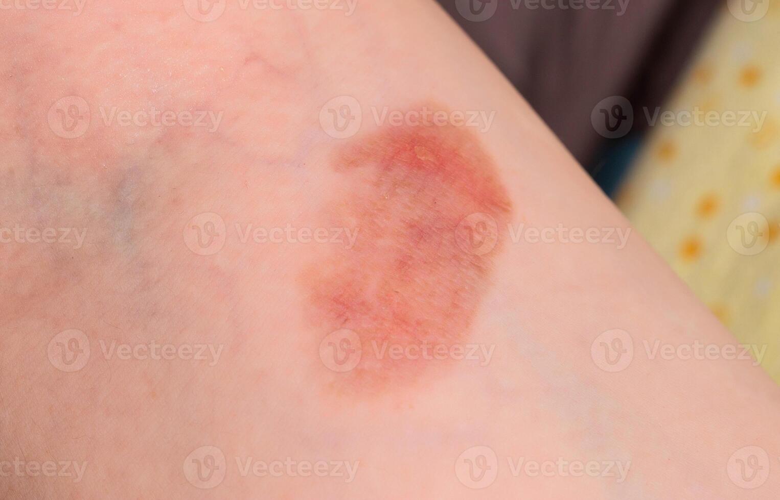 Red spot on the skin, skin damage from a burn on the arm. Close-up photo