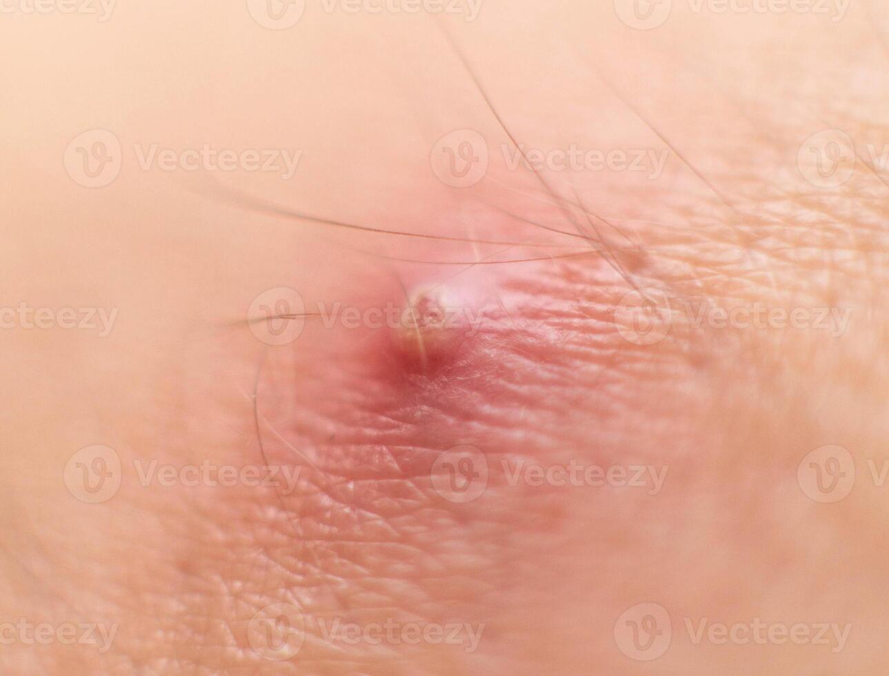 Big red boiling pimple furuncle on the skin, macro, inflamed boil, dermatology photo