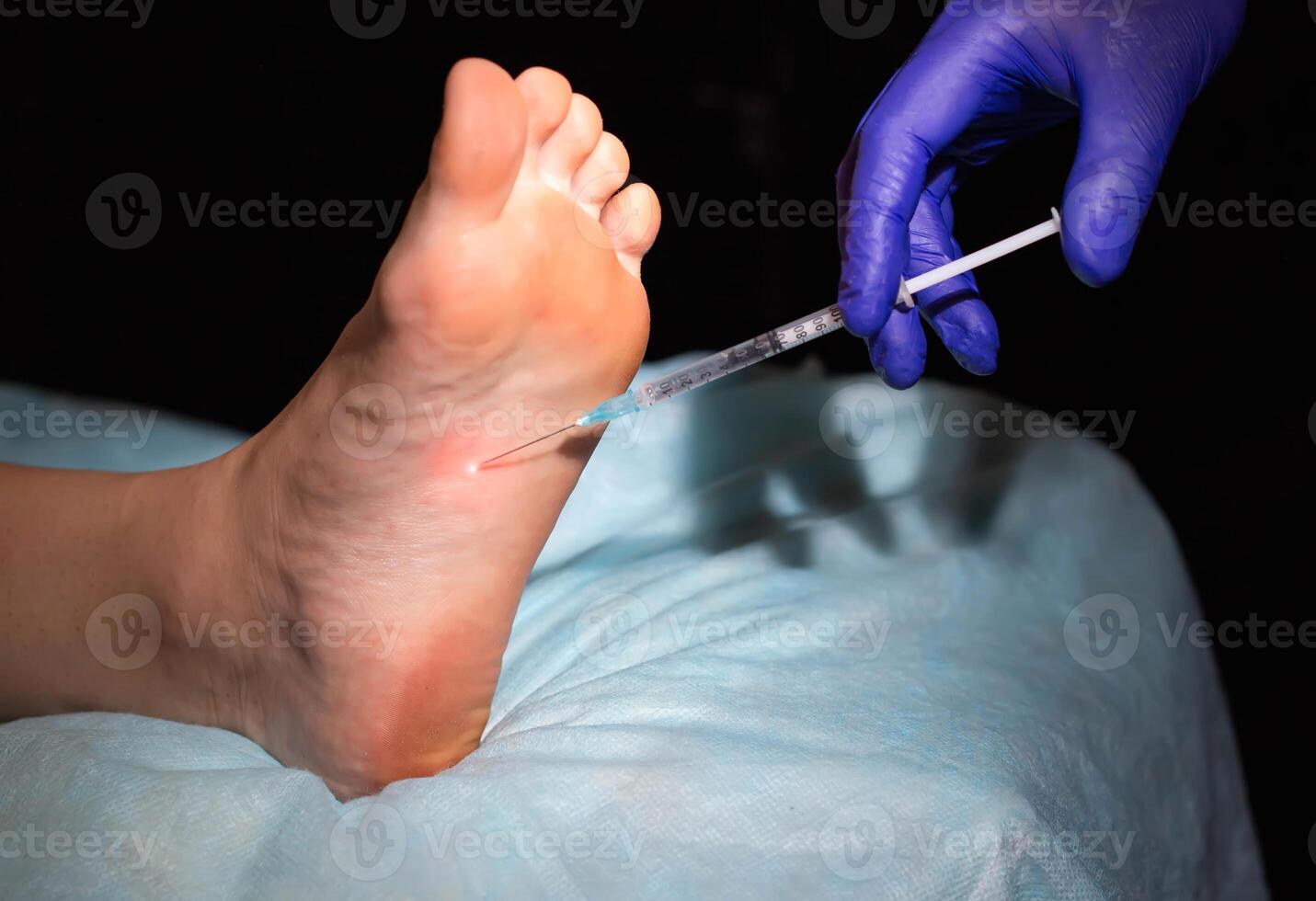 An injection against hyperhidrosis sweating in the foot of the soles of a female patient, close-up photo