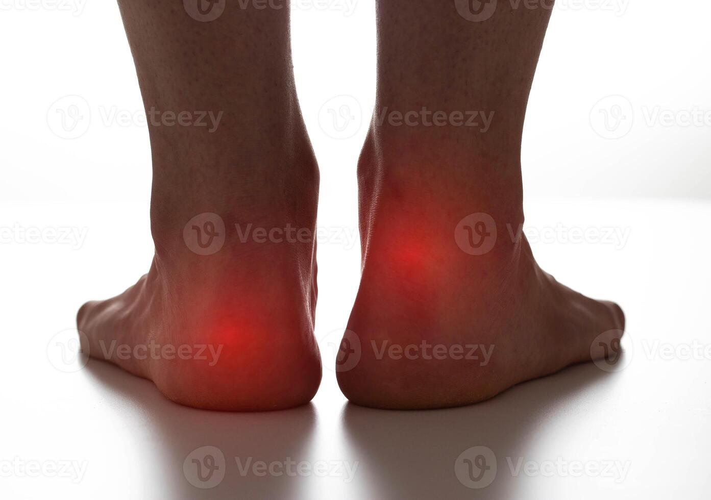 Red spots on dark female legs. Concept of pain and inflammation from calluses and warts on the feet. Close-up photo