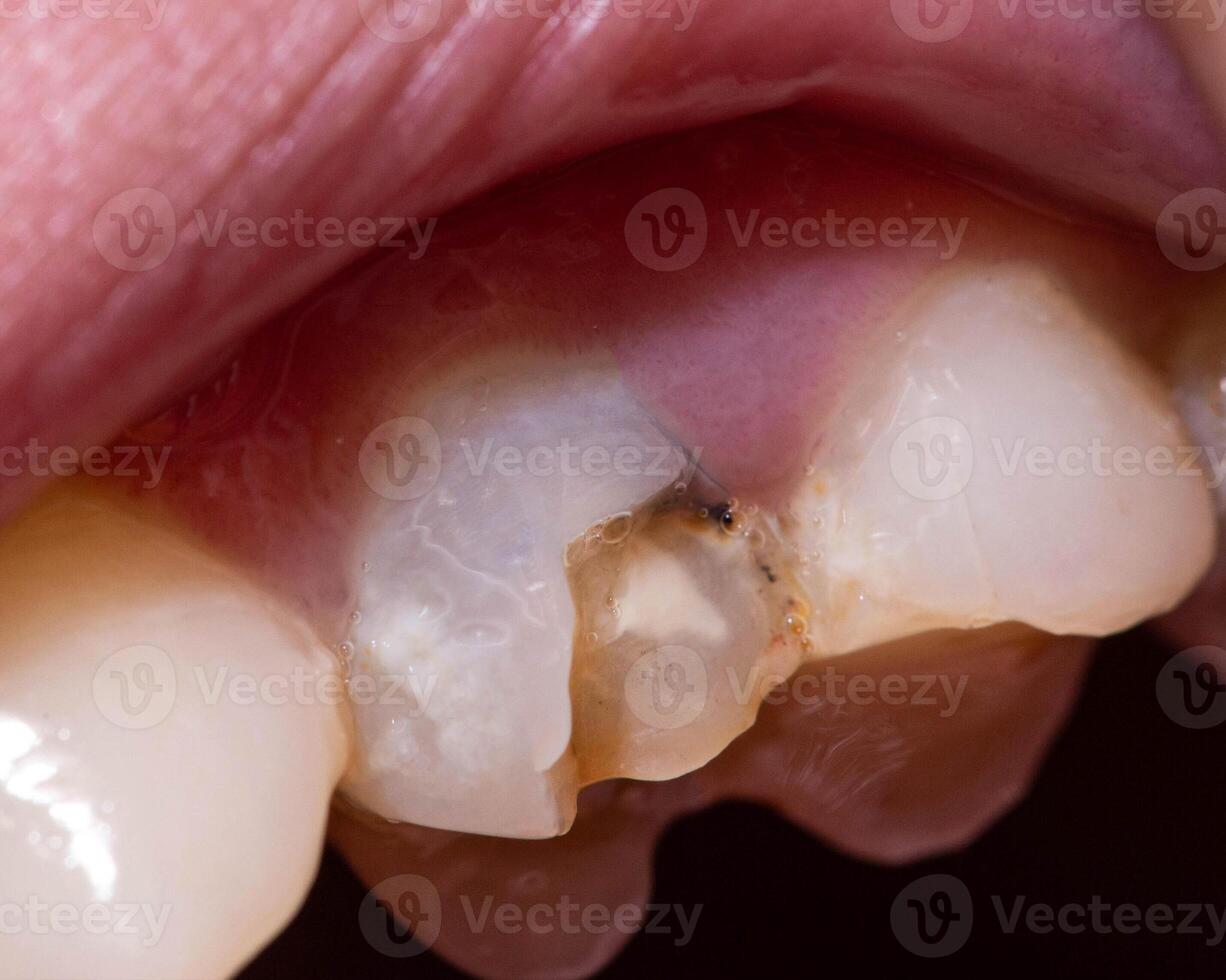 A black dead tooth in which a piece of tooth enamel is chipped off, a tooth chip. The concept of dental restoration in modern dentistry, macro photo