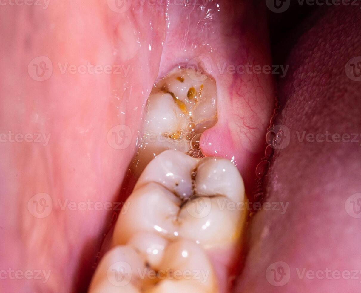 Impacted wisdom tooth due to which a gum hood was formed. Inflammation of the gums due to an unerupted molar, macro photo