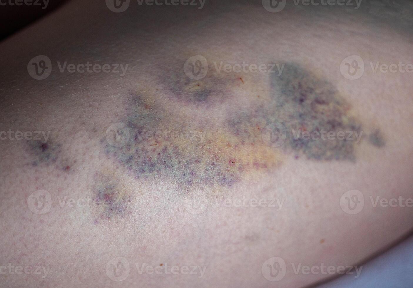 Bruises on the skin of the patient's leg after intramuscular injections of the drug. Treatment of seals and bruises after injections. photo