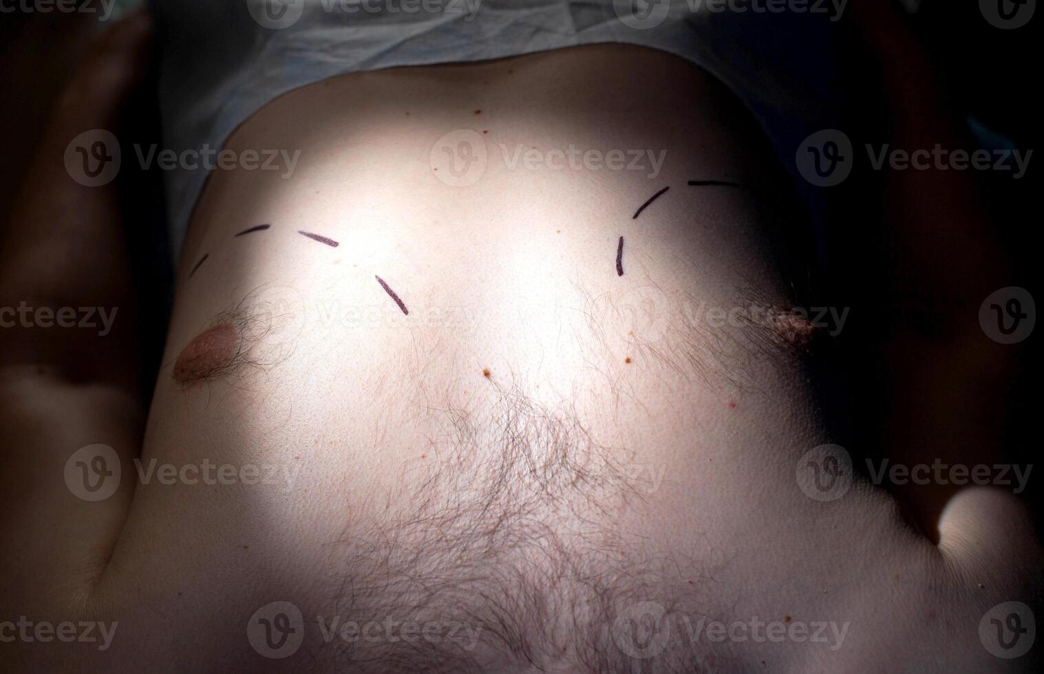 Marks on the man's chest about the correction of the man's breast. Breast correction concept, lipolysis. Gynecomastia, treatment photo