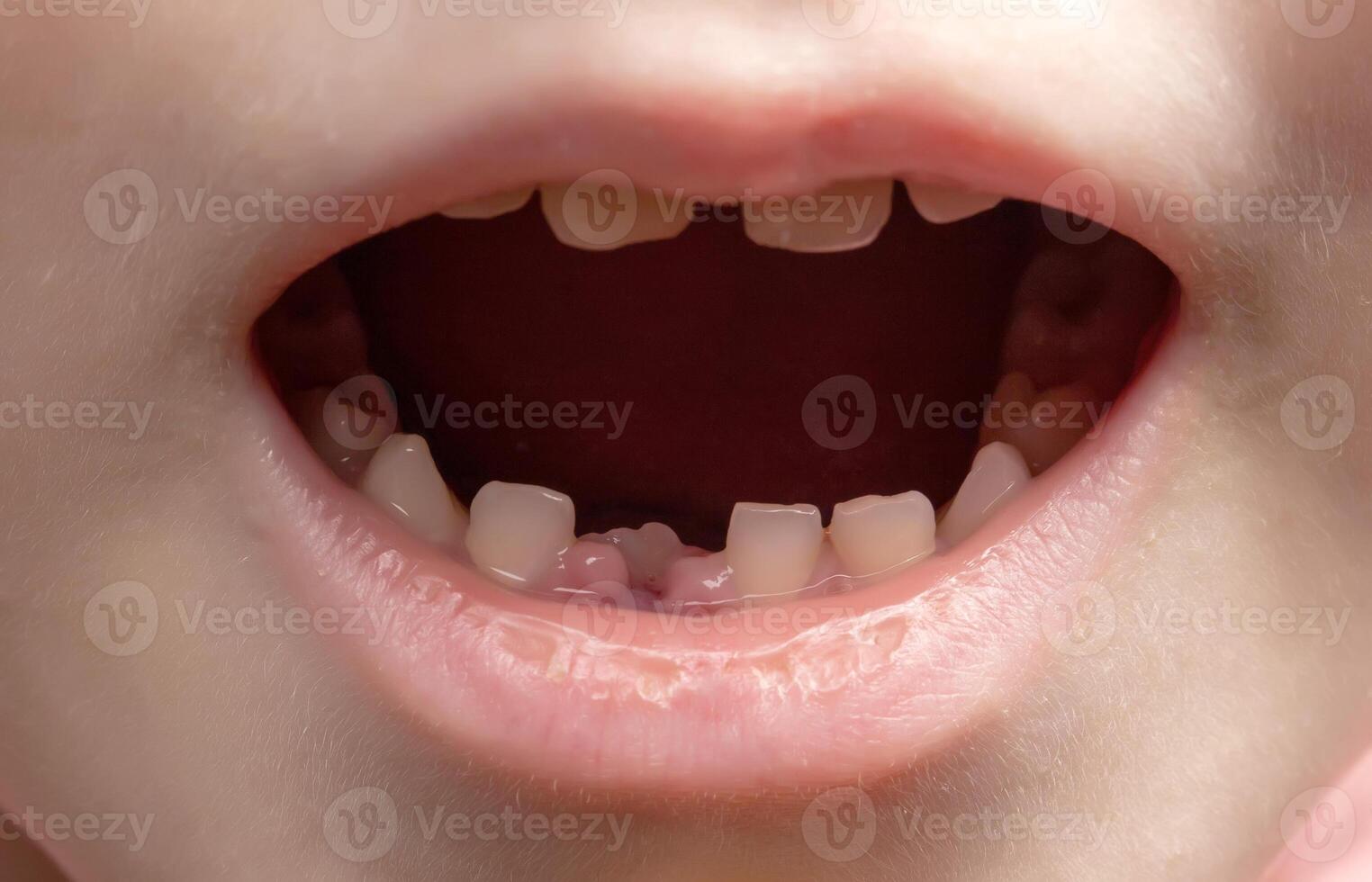 The open mouth of a child without one tooth. Loss of milk teeth. Close-up, deciduous teeth photo