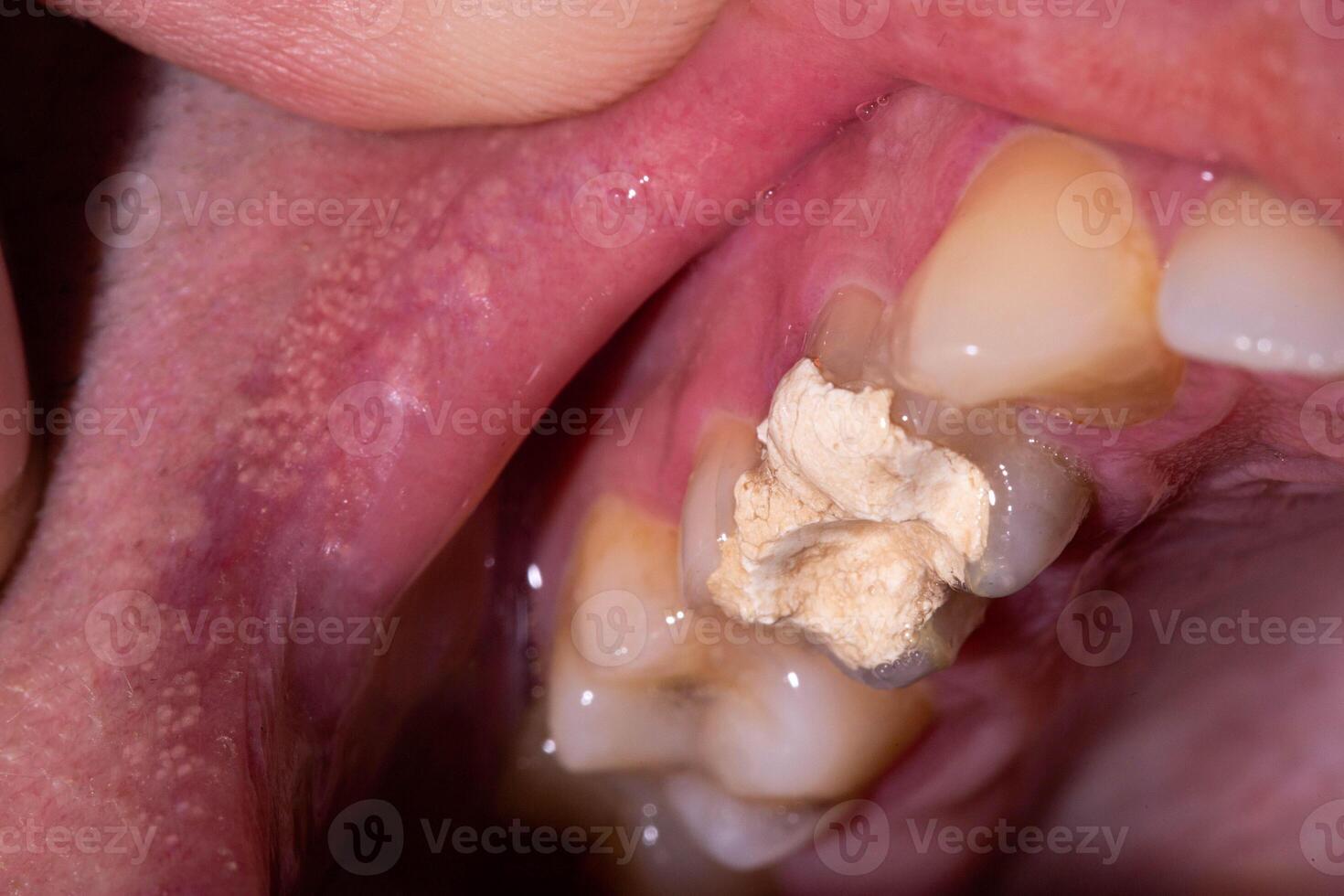 Tooth filling with temporary cement for root canal treatment. Tooth nerve removal, preparation for prosthetics, macro photo