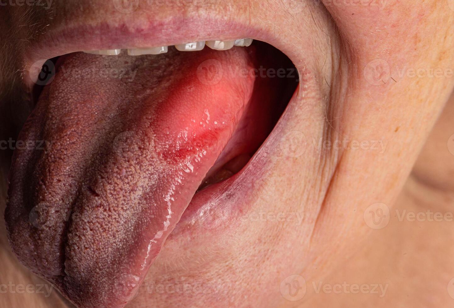 Inflammatory disease in the tongue. Red spot, glossitis. Hygiene of the tongue, close-up. Symptom of vitamin deficiency and bacteria photo