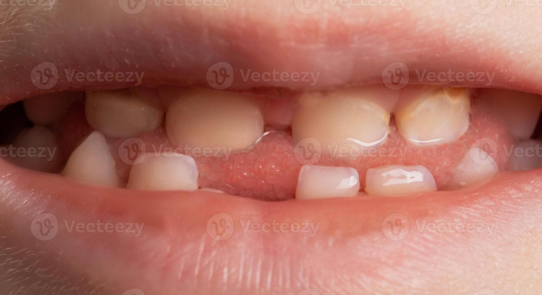 The smile of a child without one tooth in the jaw. Loss and removal of milk teeth in children, macro. Deciduous teeth photo