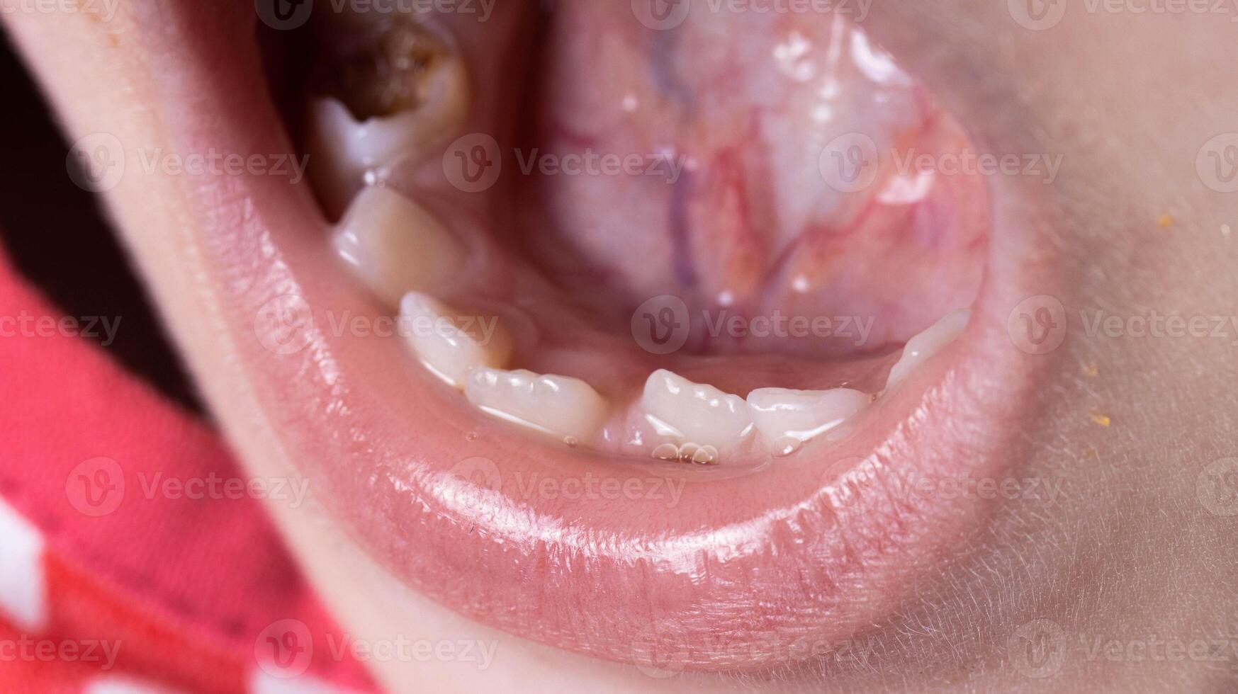 Crooked teeth in a child's mouth. The permanent tooth grows next to the milk tooth, close-up photo