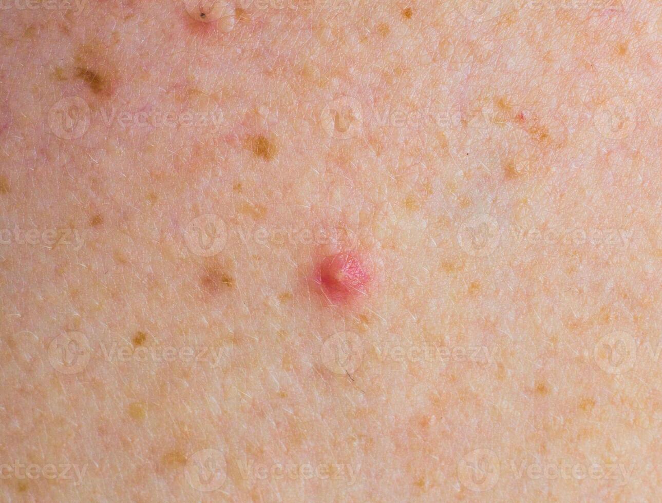 Red pimple on face macro, abscess and acne photo