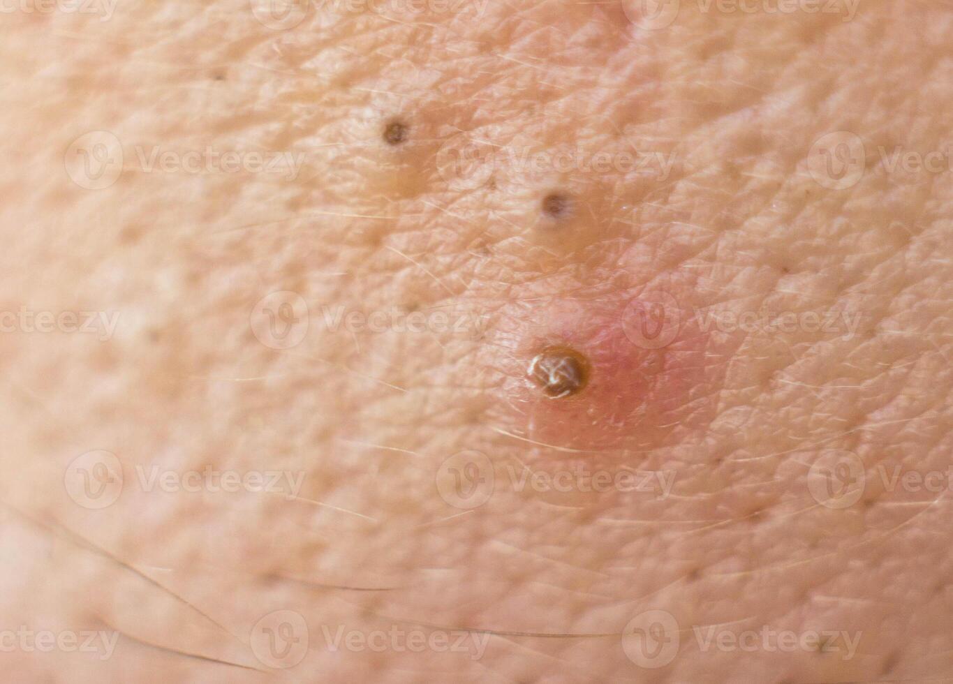 Black dots on face and pimples macro, comedo photo