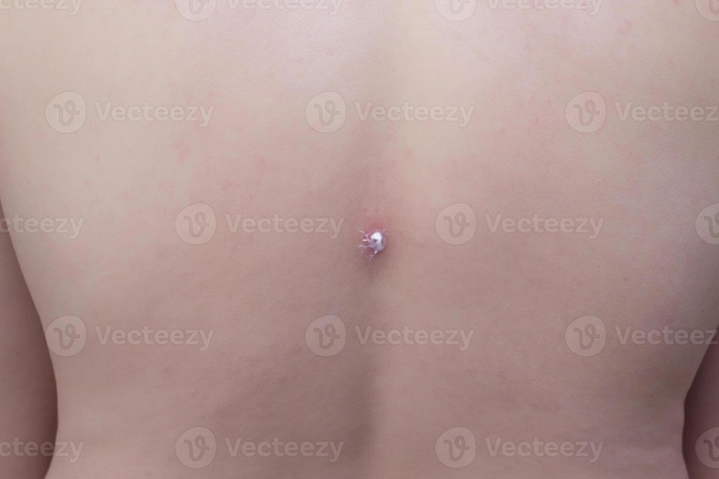 A big red pimple-boil on the back of a man treated with a healing ointment and cream, medicinal photo
